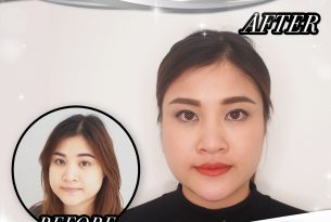 ขยัดปัญหาของสาวกรามใหญ่ ใบหน้าเหลี่ยม ด้วยการผ่าตัด RFลดกล้ามเนื้อกราม