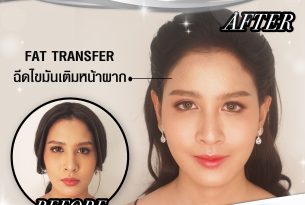 รู้ก่อนฉีดไขมันเติมหน้าผาก แก้ปัญหาหน้าผากแบนกระดูกคิ้วสูง
