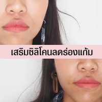 ลดร่องแก้ม