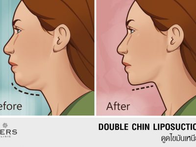 Doublechin Liposuction