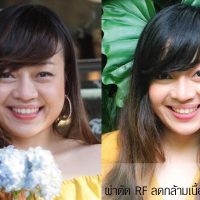 RF ลดกล้ามเนื้อกราม