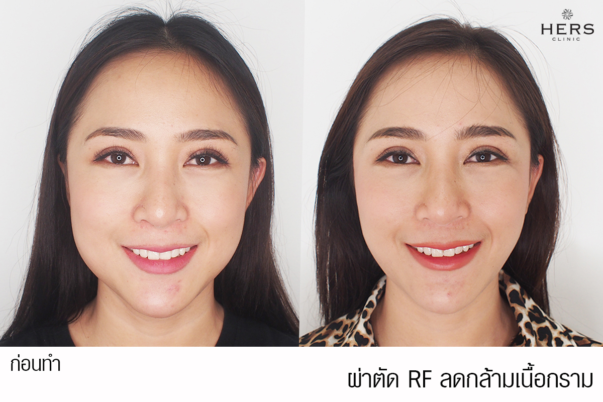 ผ่าตัด RF ลดกล้ามเนื้อกราม