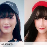 เสริมซิลิโคนลดร่องแก้ม