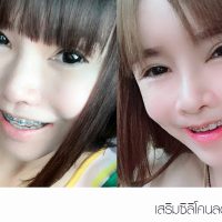 ลดร่องแก้ม