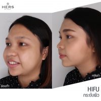 รีวิว HIFU