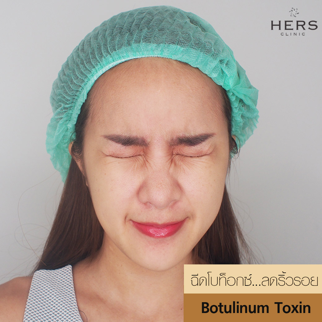 ลดริ้วรอย BOTOX