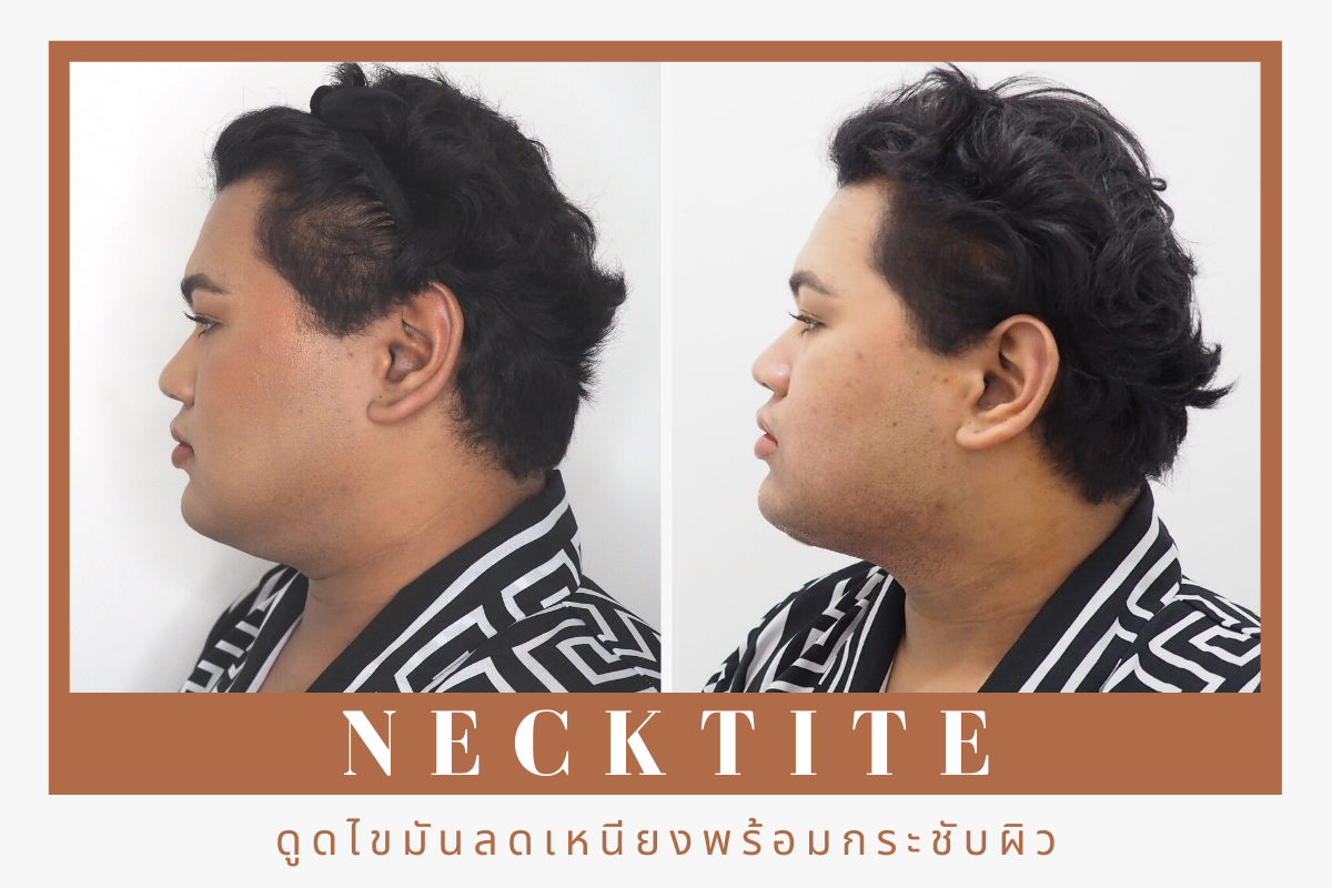 Necktite