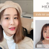 รีวิว RF ลดกรามคุณคุณ