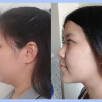 Before – After Necktite