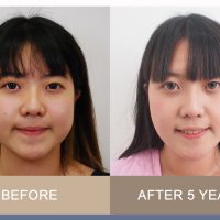 5801137 – รีวิวผ่าตัดไขมันกระพุ้งแก้ม