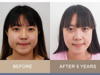 5801137 – รีวิวผ่าตัดไขมันกระพุ้งแก้ม