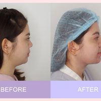 รีวิวลดเหนียง Necktite