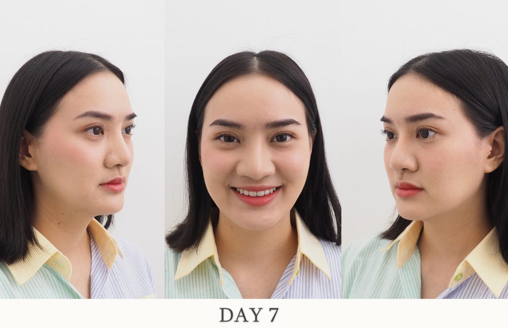 รีวิว ผ่าตัด ไขมันกระพุ้งแก้ม