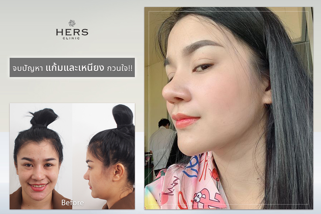 ดูดไขมันเหนียงและกรอบหน้า