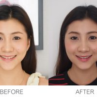 6200557 รีวิว ผ่าตัดไขมันกระพุ้งแก้ม