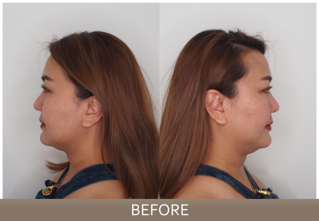 รีวิว Necktite ลดเหนียง กรอบหน้าชัด
