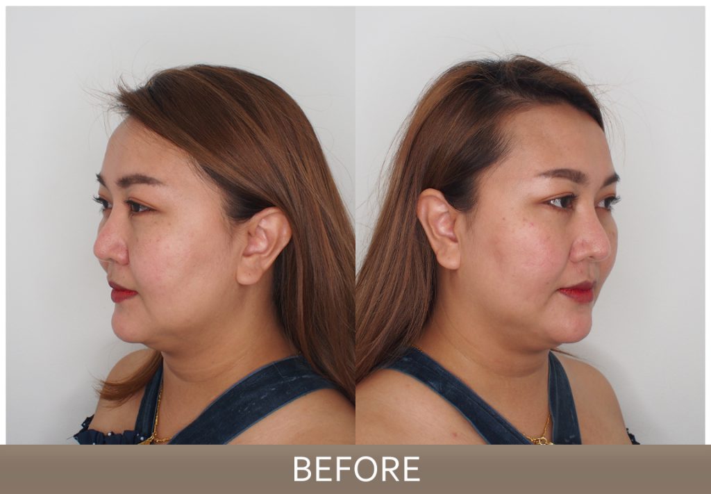 รีวิว Necktite ลดเหนียง กรอบหน้าชัด