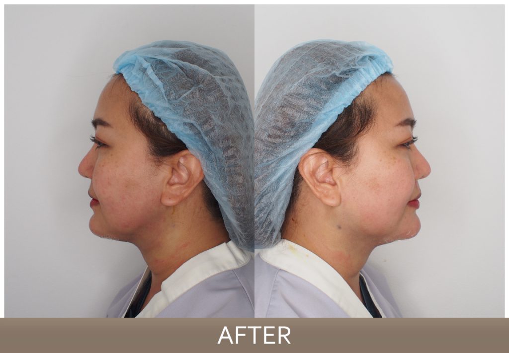 รีวิว Necktite ลดเหนียง กรอบหน้าชัด