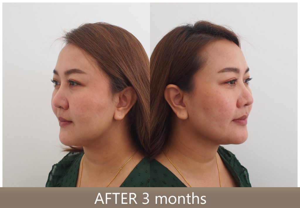 รีวิว Necktite ลดเหนียง กรอบหน้าชัด