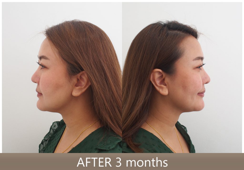 รีวิว Necktite ลดเหนียง กรอบหน้าชัด