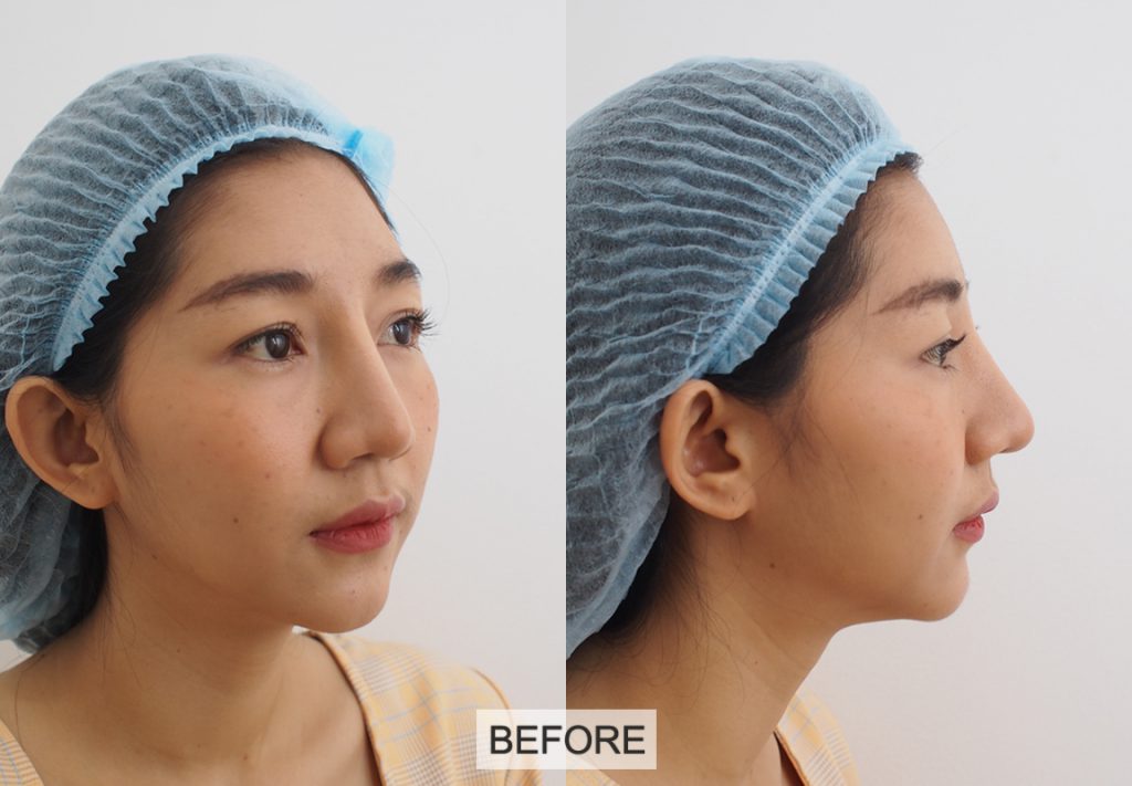 630626 รีวิว เสริมซิลิโคน หน้าผาก Hers Clinic