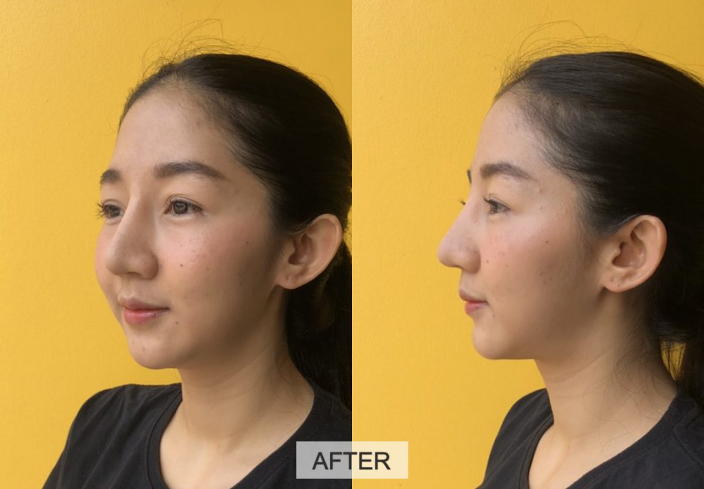 630626 รีวิว เสริมซิลิโคน หน้าผาก Hers Clinic