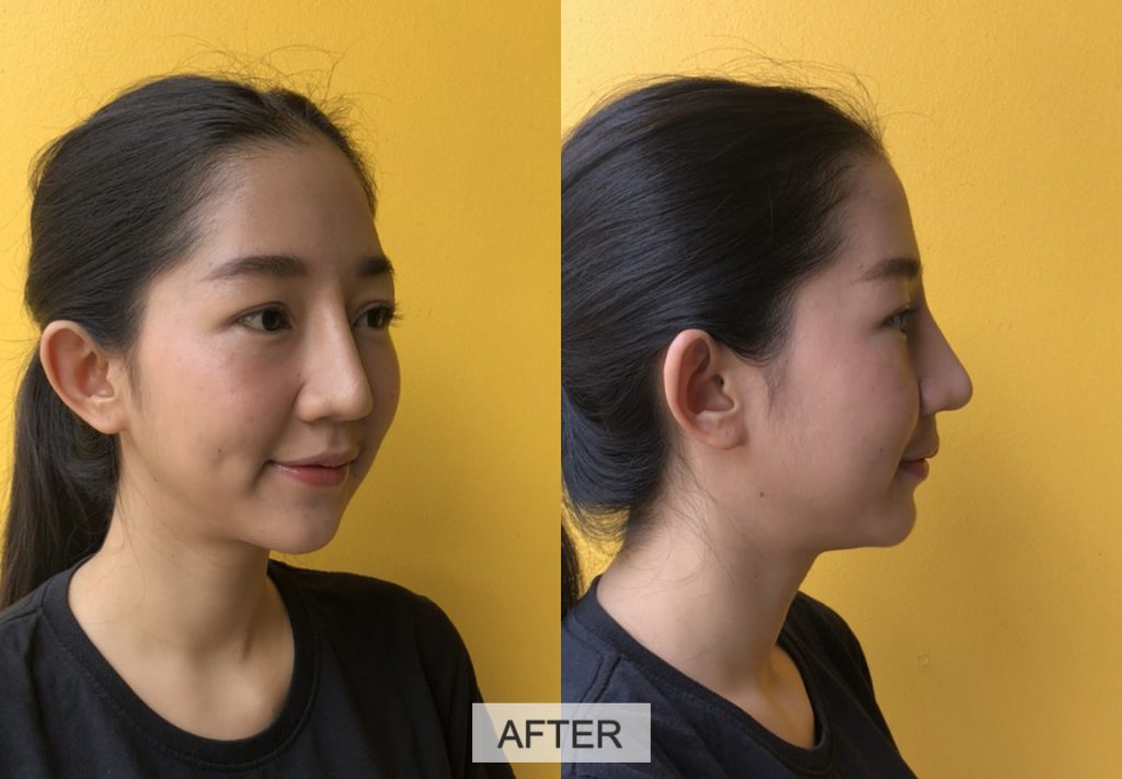 630626 รีวิว เสริมซิลิโคน หน้าผาก Hers Clinic