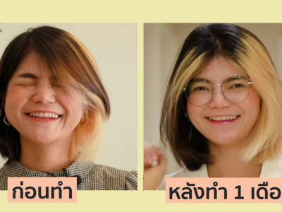 รีวิว 1เดือน บอกลา หน้ากลม คัดไขมันกระพุ้งแก้ม