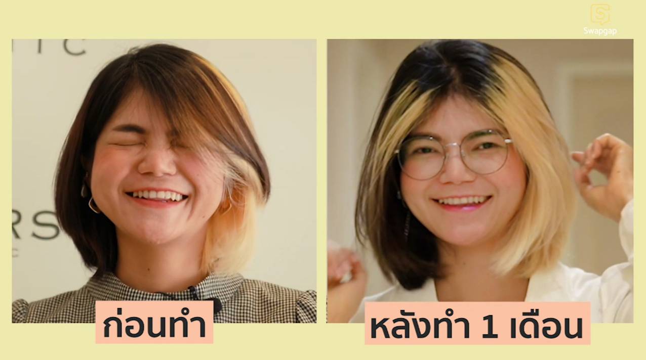 รีวิว 1เดือน บอกลา หน้ากลม คัดไขมันกระพุ้งแก้ม
