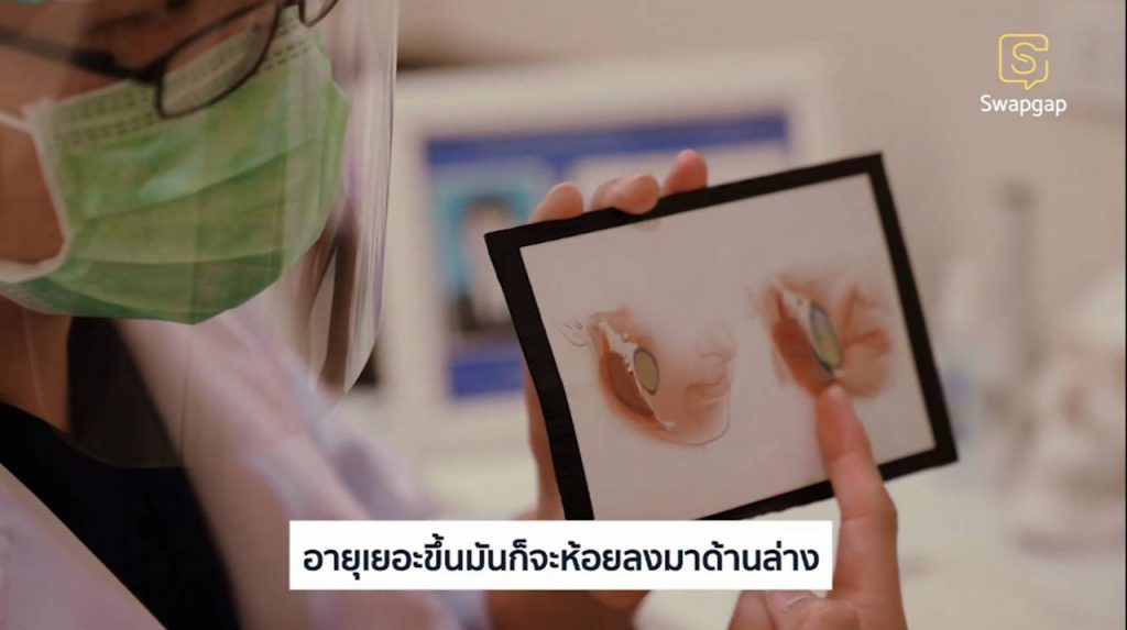 การผ่าตัดไขมันกระพุ้งแก้ม เวลายิ้มแล้วหน้าไม่บาน