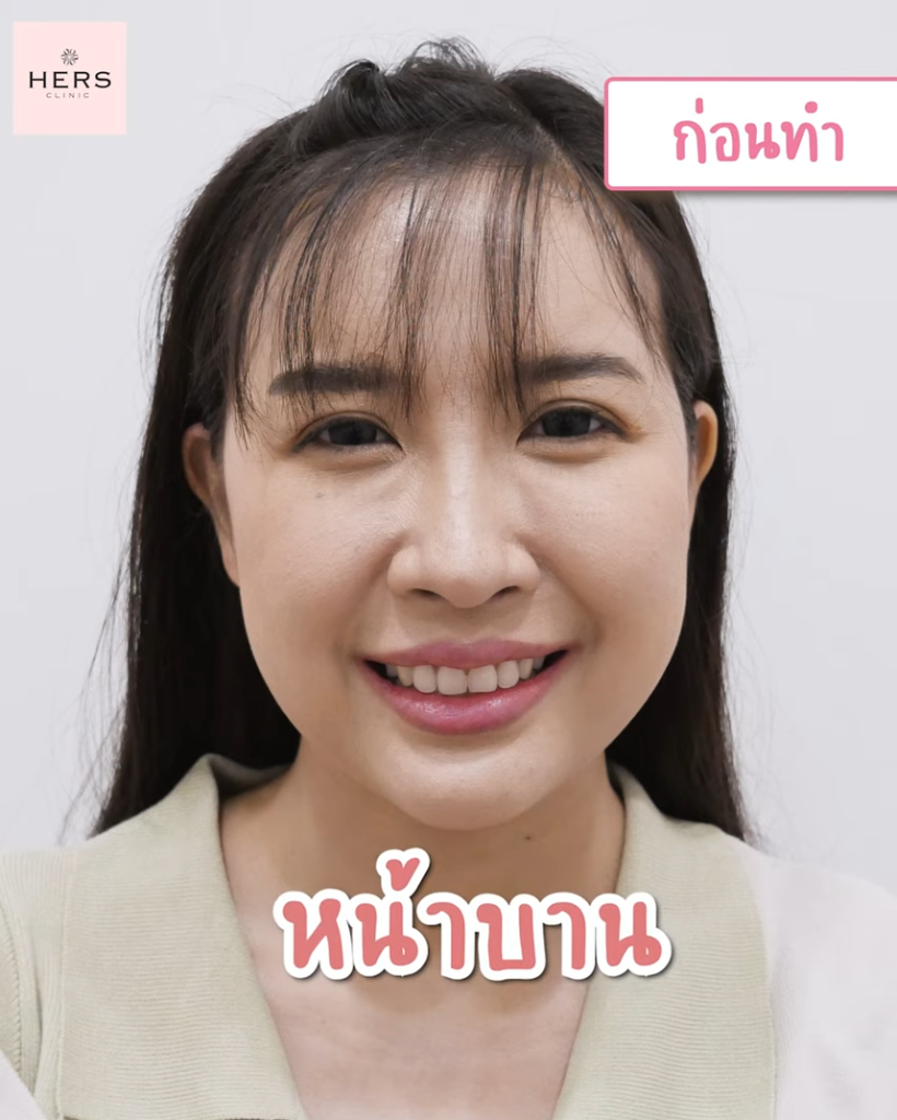 แก้มใหญ่ แก้มย้อย หน้าบาน ยิ้มแล้วหน้าบาน 