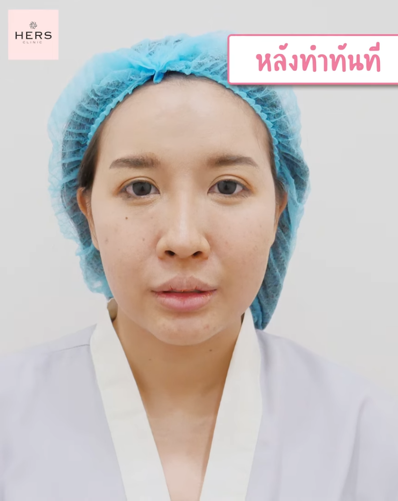 รีวิวหลังตัดไขมันกระพุ้งแก้ม แก้มเล็กลง หน้าเรียว