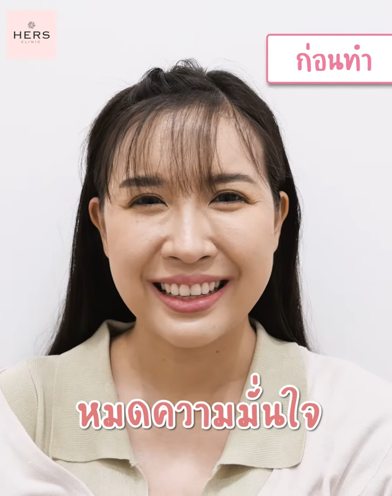 หน้าเล็ก หน้าเรียว แก้มเล็กลง หน้าไม่บาน