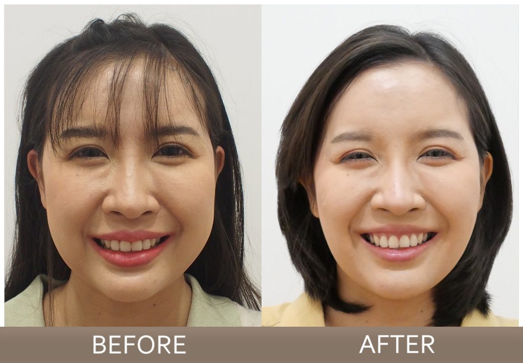 Before - After หลังผ่าตัดไขมันกระพุ้งแก้ม แก้มเล็กลง หน้าเรียว กระชับ 