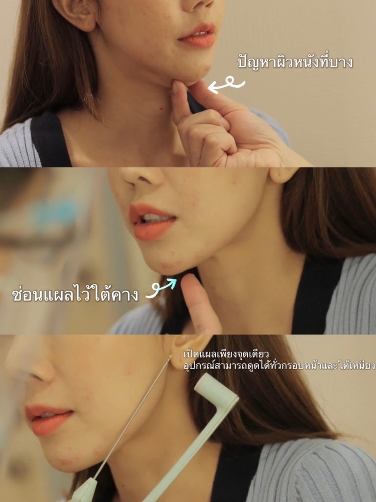 เครื่องมือทันสมัย กระชับผิวด้วย Necktite 