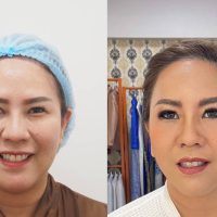 ฉีดไขมันเติมหน้า