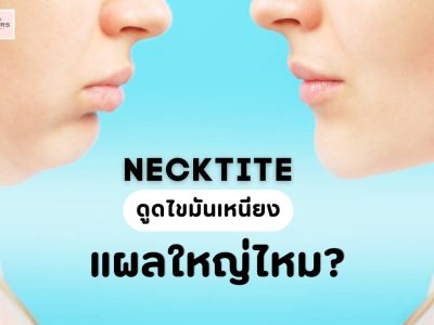 Necktite ดูดไขมันเหนียง แผลใหญ่ไหม