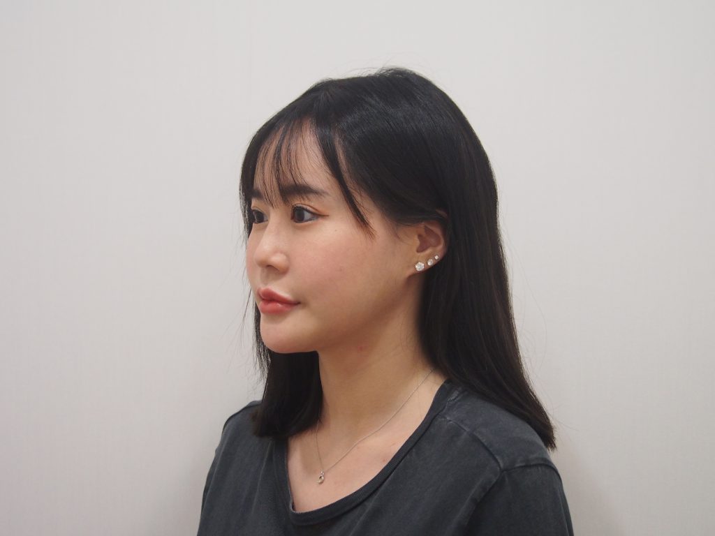 เสริมซิลิโคนร่องแก้ม