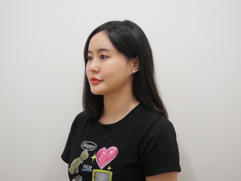 เสริมซิลิโคนร่องแก้ม