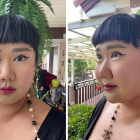 หลังผ่าตัดลดเหนียง