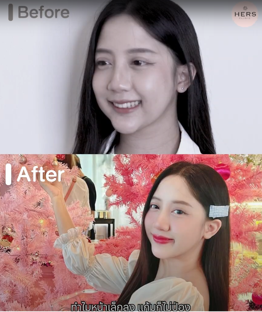 ตัดไขมันกระพุ้งแก้ม